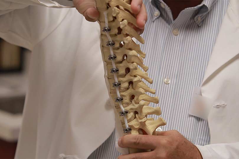 Un médico sosteniendo un modelo de una columna vertebral con el dispositivo Tether colocado
