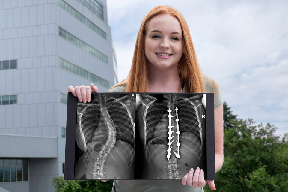 un patient atteint de scoliose tenant des radiographies avant et après