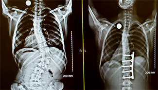 Before and after X-rays