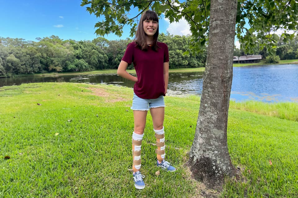 female patient wearing prosthetics on both legs