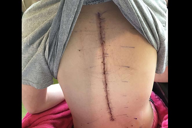 Malorie's back scar