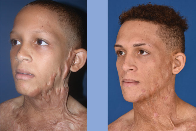Fotografías de Leufrey antes y después de la cirugía