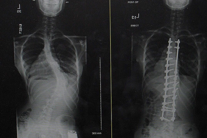El antes y después de las radiografías de la columna vertebral de Elliana