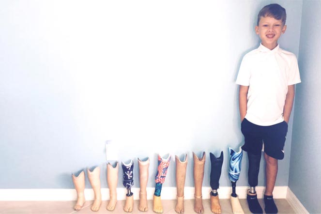 zavi with prosthetic legs