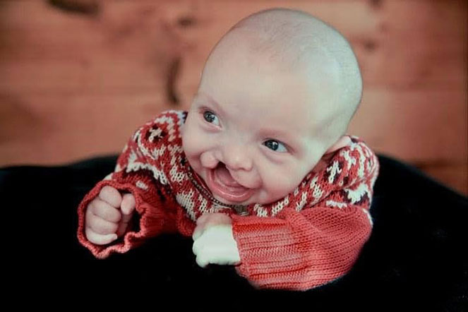 Peyton de bebé con labio leporino
