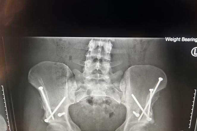 Radiografía de Kiana después de la cirugía
