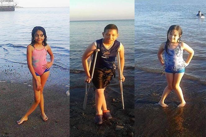three siblings at beach, all with skeletal dysplasia