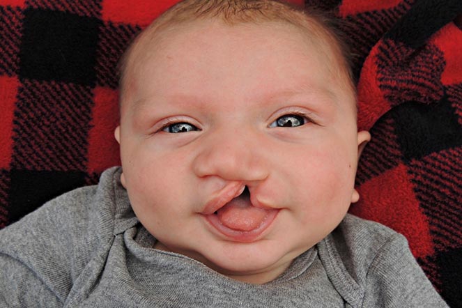 Baby Hunter, cleft lip patient