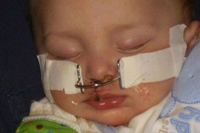 Bébé Zachary après une chirurgie cranio-faciale