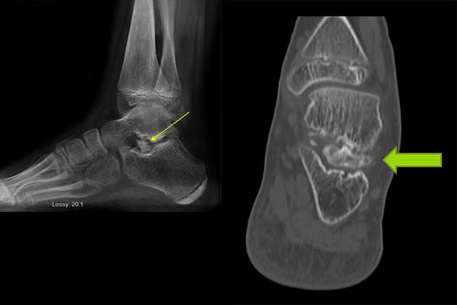 Radiografía de pie