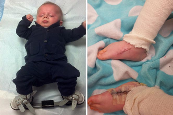 Jace wearing boots and bar, jace's feet after surgery