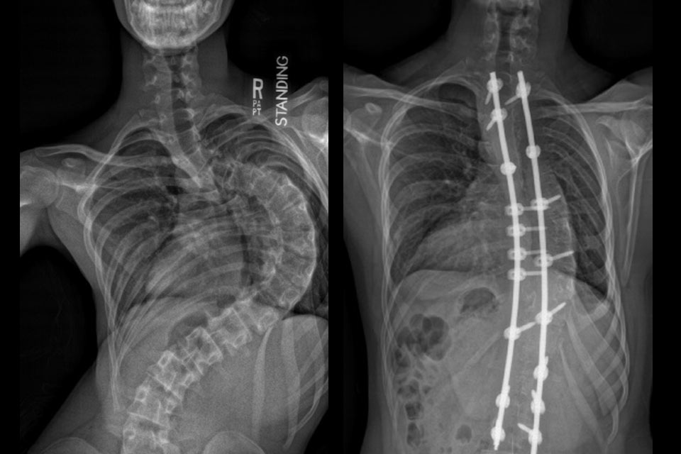 Antes y después de la radiografía de torso