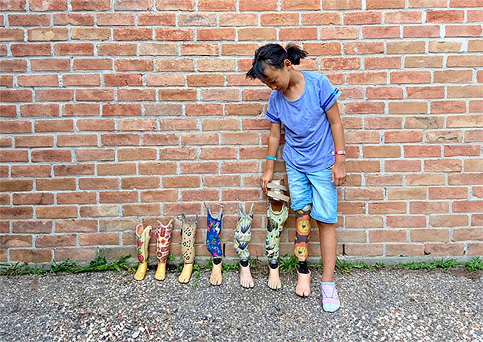 patient standing next to all of her previous prosthetics