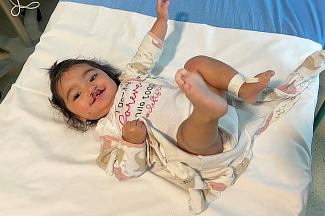 Cleft lip patient smiling in hospital bed