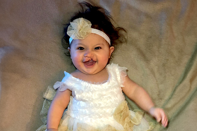 Cleft lip patient in headband and dress, smiling