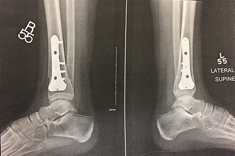 X-ray of tibias post surgery with steel plate screws for internal tibial torsion