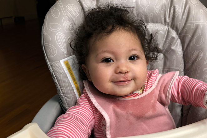 Cleft lip patient smiling in high chair