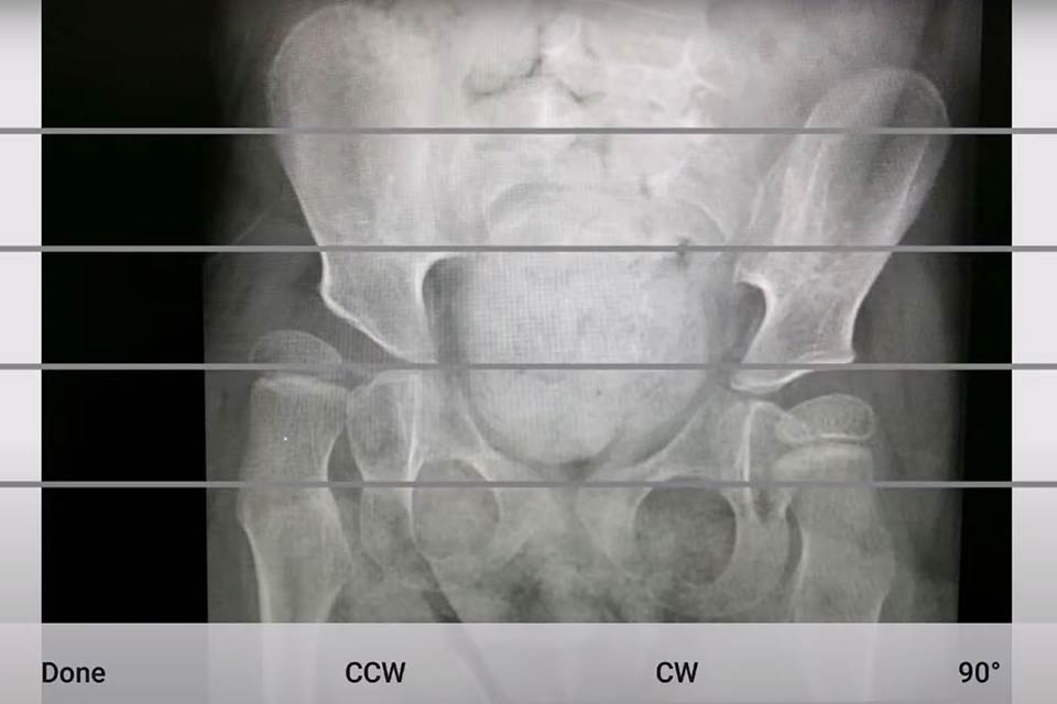 Capture d'écran de la fonction de règle HipScreen