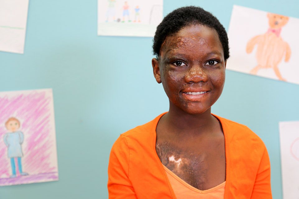 une adolescente avec des cicatrices de brûlure