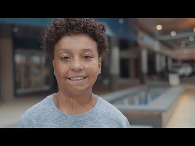 Specialized Burn Care at Shriners Children's Ohio